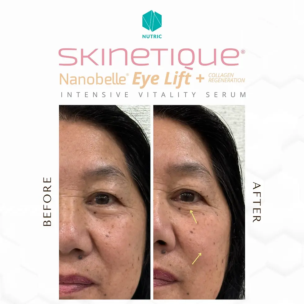 Skinetique Nanobelle - Before After Testimony