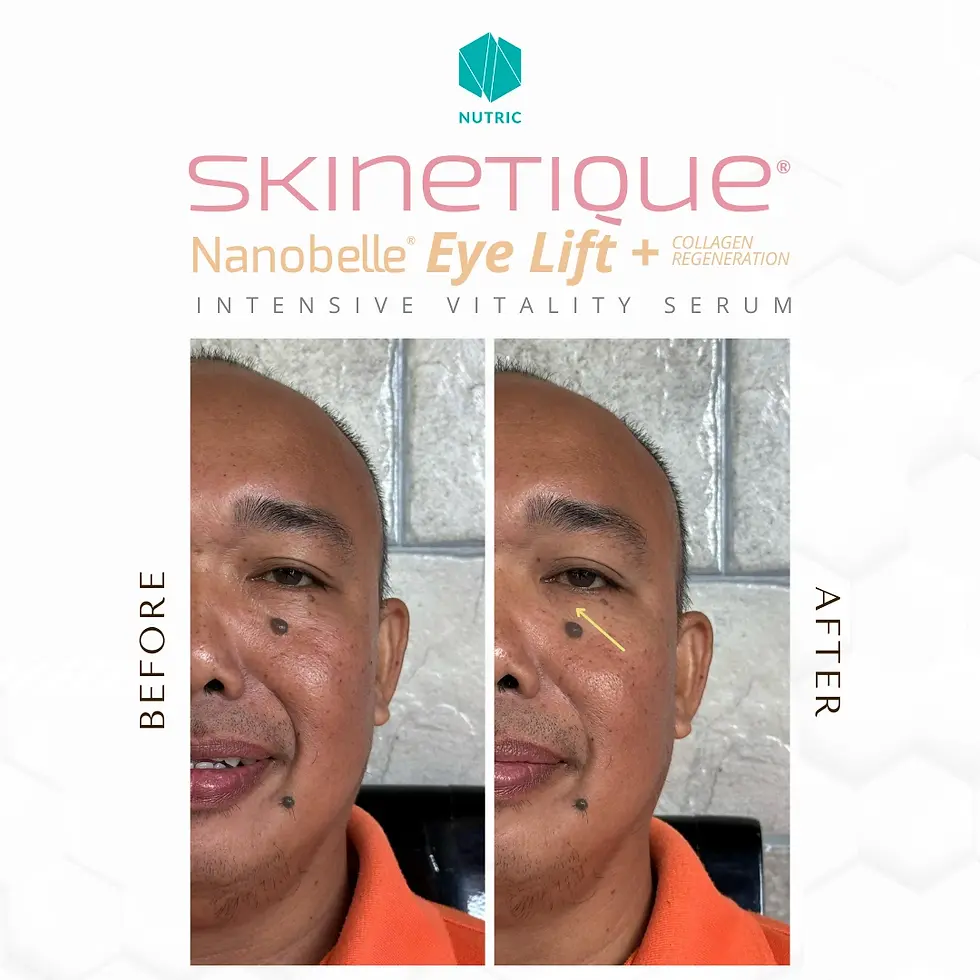 Skinetique Nanobelle - Before After Testimony