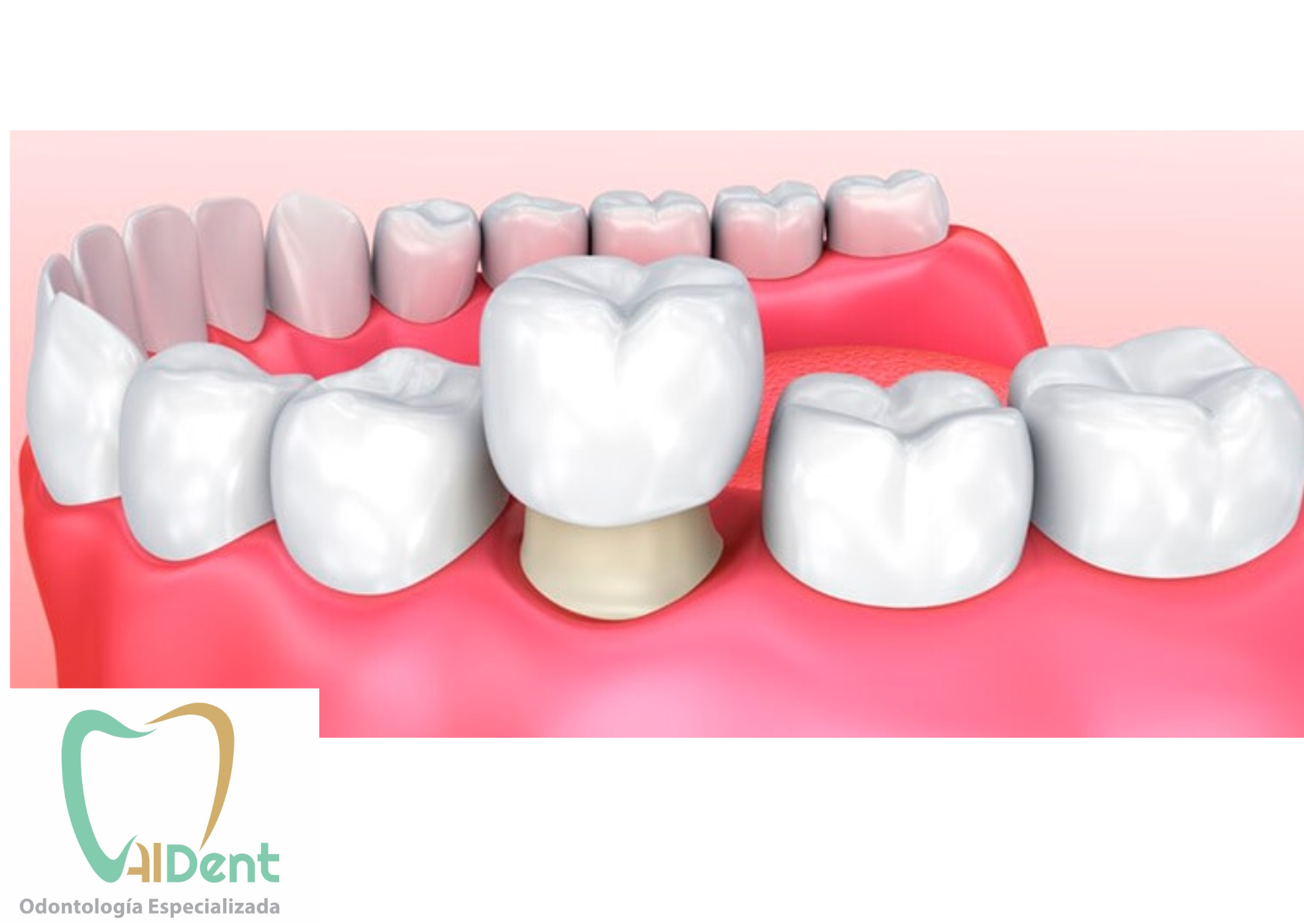 CORONA ZIRCONIO PZ (UNIDAD)