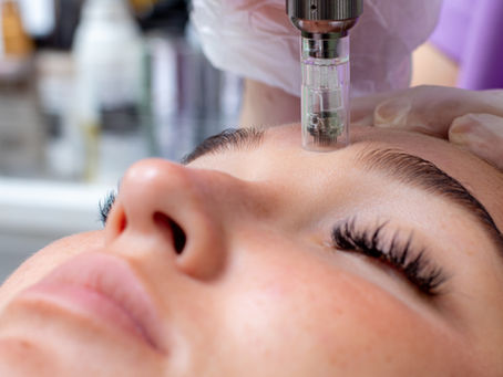 Microneedling: wat doet het eigenlijk met je huid?