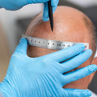 male-going-through-follicular-unit-extraction-process.jpg