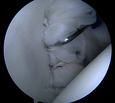 ShoulderArthroscopy_2018-07-24-062532_Sk