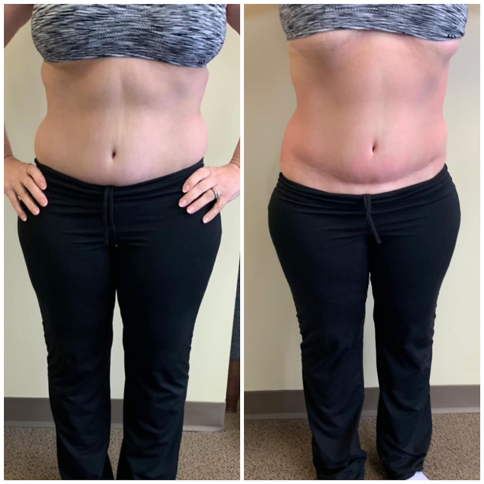 before-after-woman-16-love-tummy-front-view
