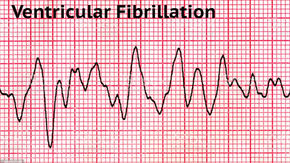 Ritmos chocáveis e não Chocáveis