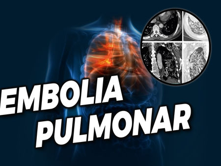 O que é embolia gasosa disseminada que levou o ator Paulo Gustavo a Morte?
