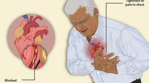 Você conhecer o INFARTO AGUDO DO MIOCARDIO?