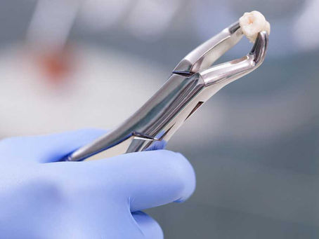 Cuidados que debes tener después de una extracción dental
