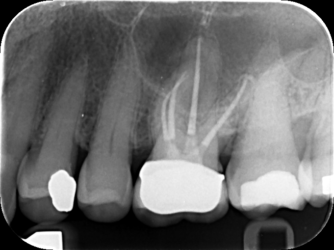 Postoperative 26 retreatment