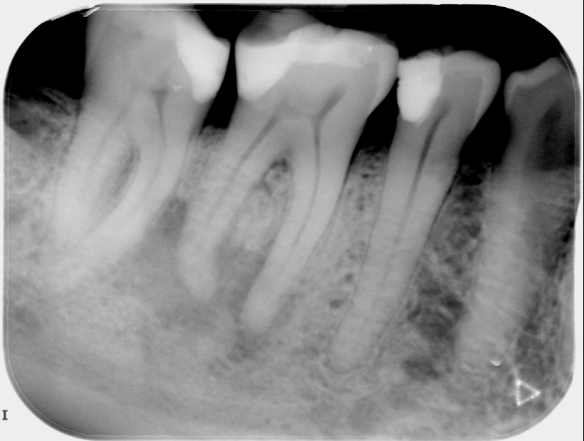 Primary Endodontic Treatment Preoperative