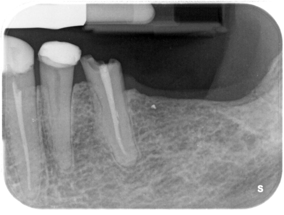 Endodontic Retreatment Preoperative