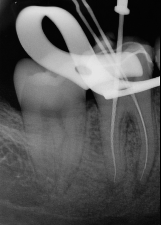 Primary Endodontic Treatment Through Crown