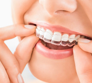 Invisalign