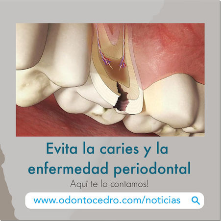 Evita la caries y la enfermedad periodontal