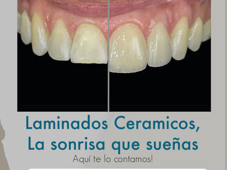 Laminados Cerámicos: La Sonrisa que sueñas