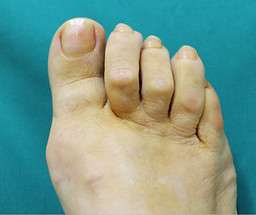 problema_pie_dedos-en-garra