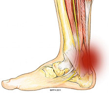 problema_pie_tendón-Aquiles