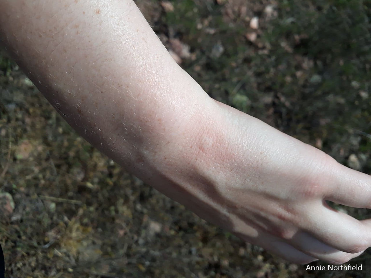 A pink wasp sting on my pasty white hand