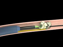 Ενδοσκοπική Λιθοτριψία