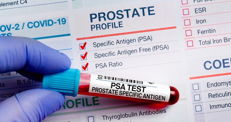 PSA test