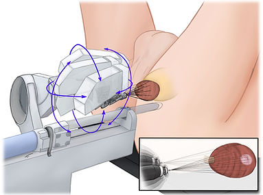 Fusion Βιοψία Προστάτη