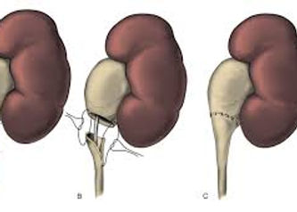 laparoskopische Pyeloplastik