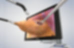 3D Λαπαροσκοπική Ριζική Προστατεκτομή