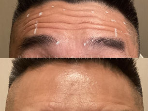 Discover the Benefits of Botox and Why Dysport is Our Top Choice!