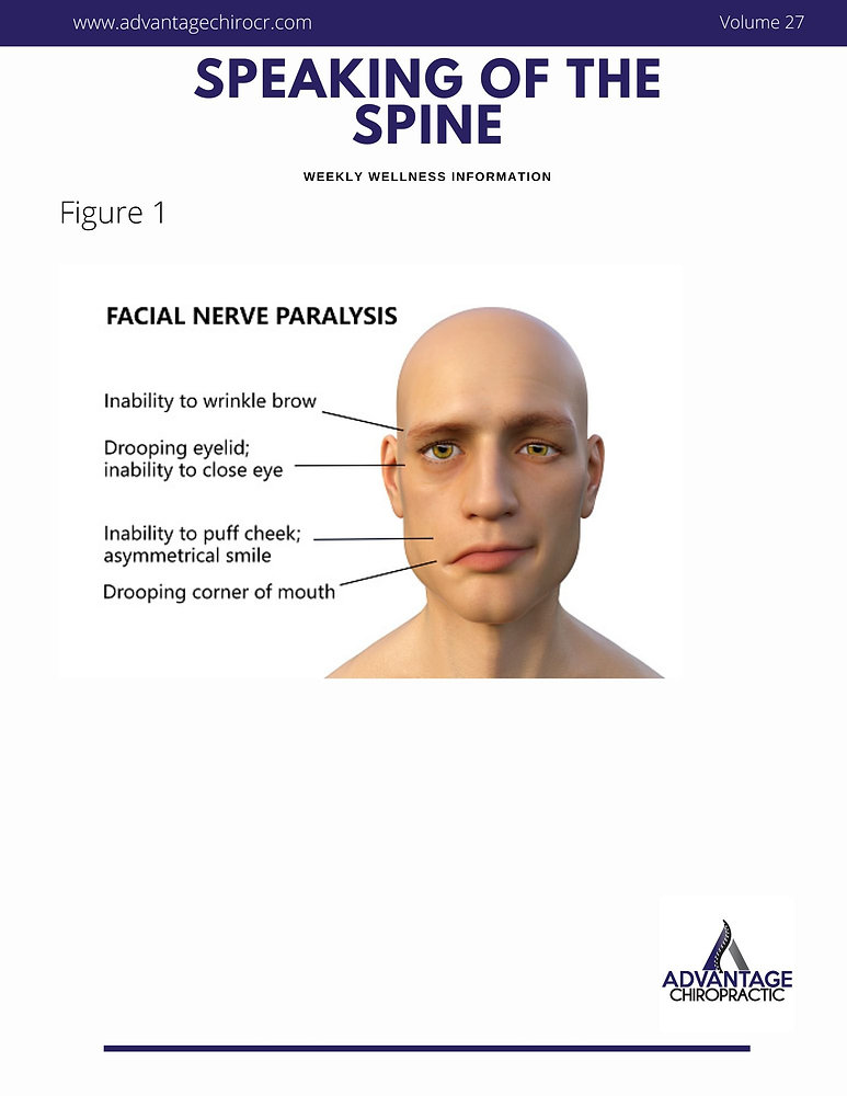 Bell s Palsy Case Study bell-s-palsy-case-study