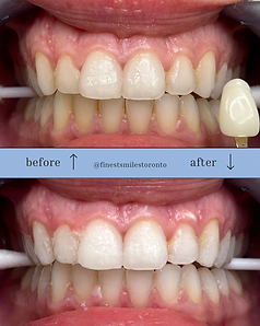 Before and after treatment of teeth