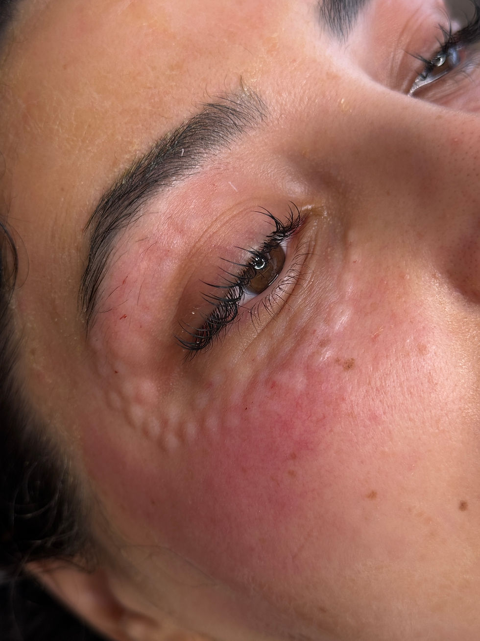 Eye rejuvenation