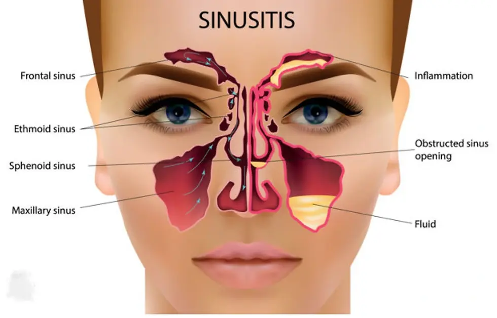 different types of Sinusitis