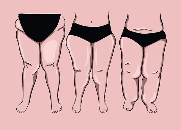 Lipedema-Canada_Homepage-illustrations.webp