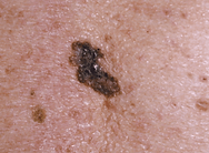 Melanoma