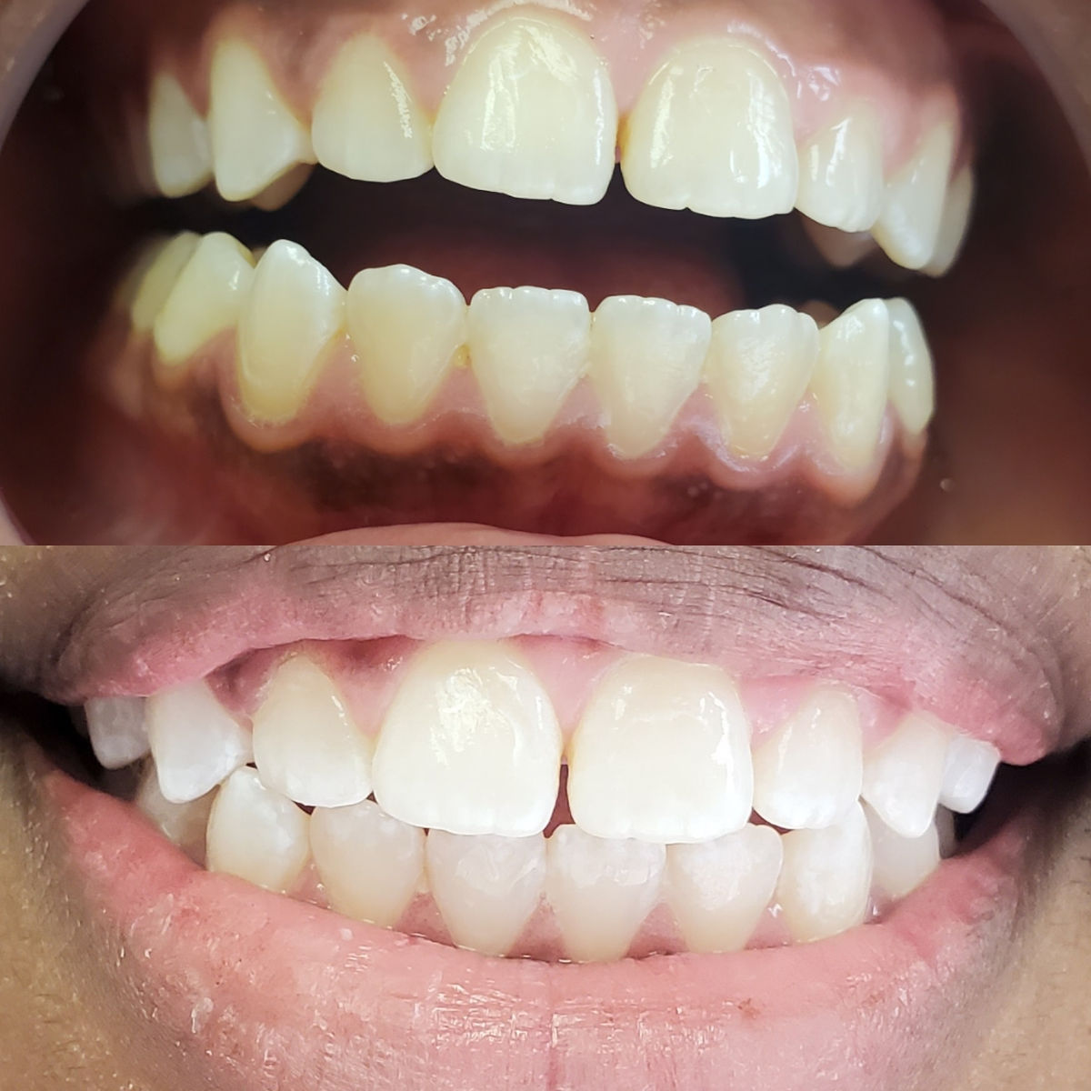 Arizona Teeth Whitening