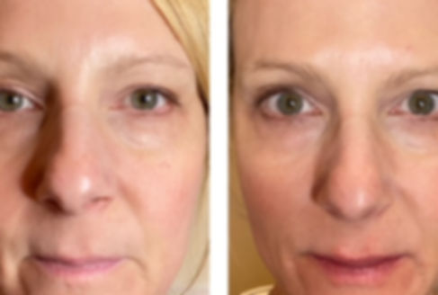 Before and after PRP filler.JPG