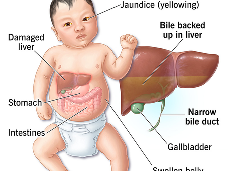 Biliary Atresia Explained: From Diagnosis to Treatment