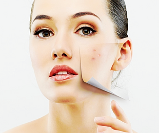 Pattanásra, pattanás kezelése, rosacea, ekcémára