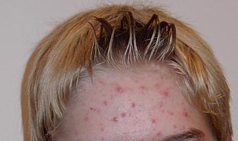 Pattanásra, pattanás kezelése, rosacea, ekcémára