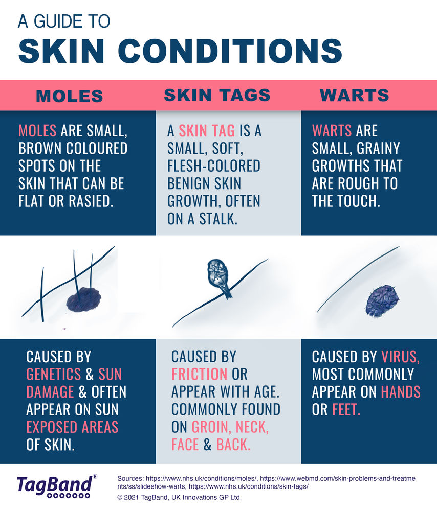 Do I have a skin tag, wart, or mole? What's the difference?