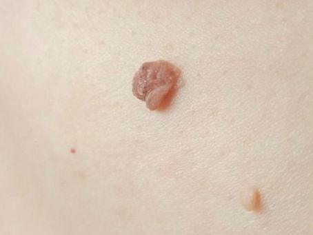 Can Skin Tags shrink on their own?