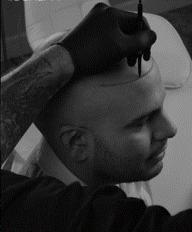 scalp1.GIF