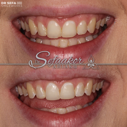 Composite Edge Bonding