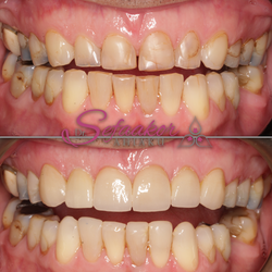 Porcelain Veneers