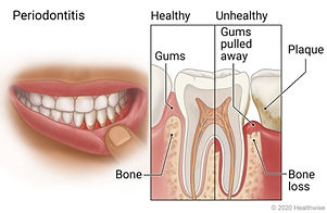 illustrated image of the inside of a tooth and gums