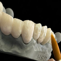 Porcelain fused to zirconia bridge