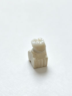 Porcelain fused to metal