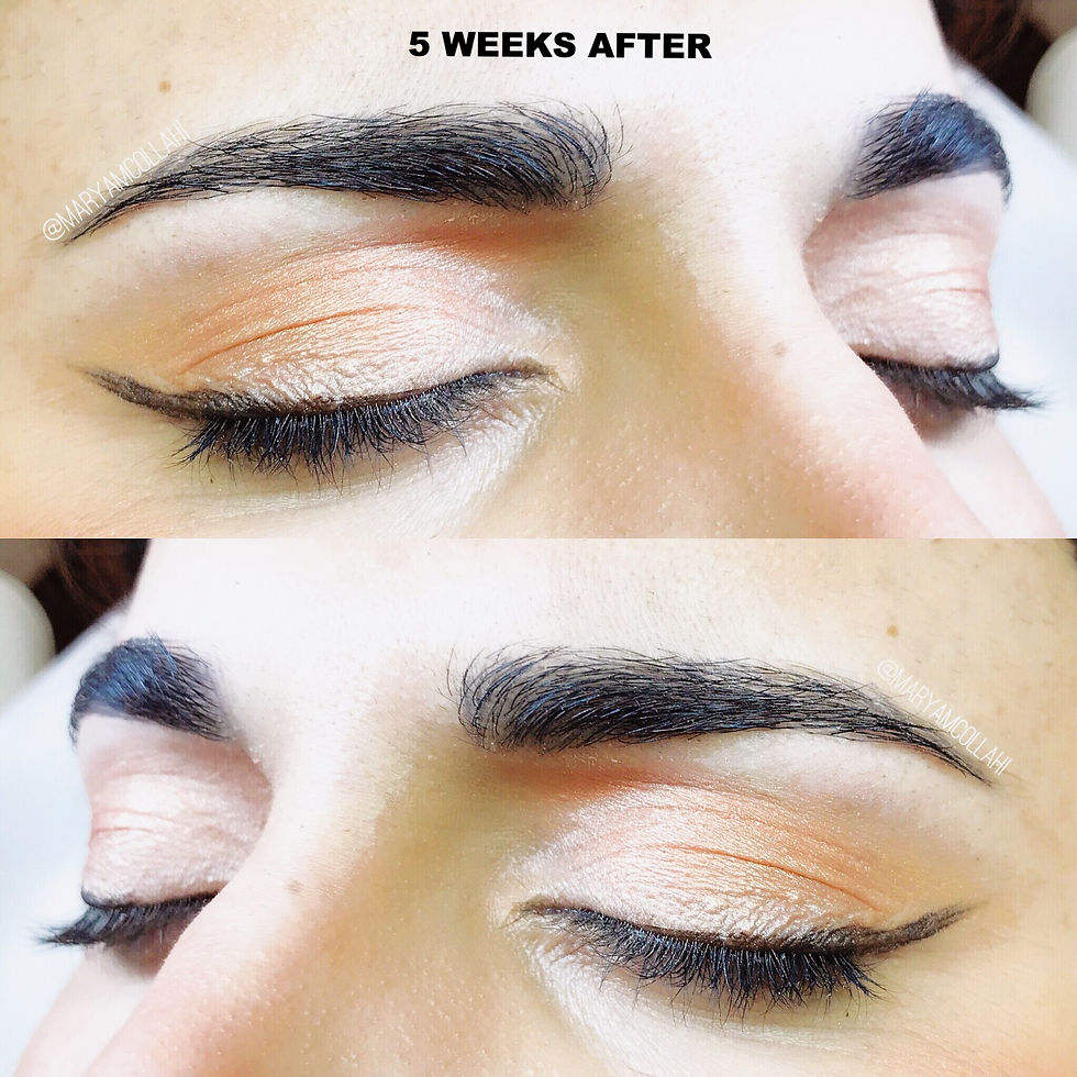 5 WEEKS AFTER THE FIRST PROCEDURE