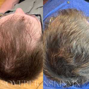 Before and after scalp micropigmentation density fill on a man, healed result