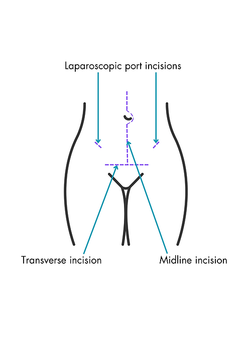 Midline incision.png