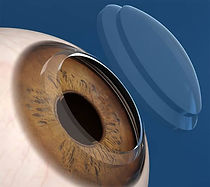 cornea.jpg